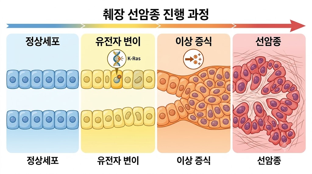 췌장암 원인 췌관 선암종 세포 변이 메커니즘