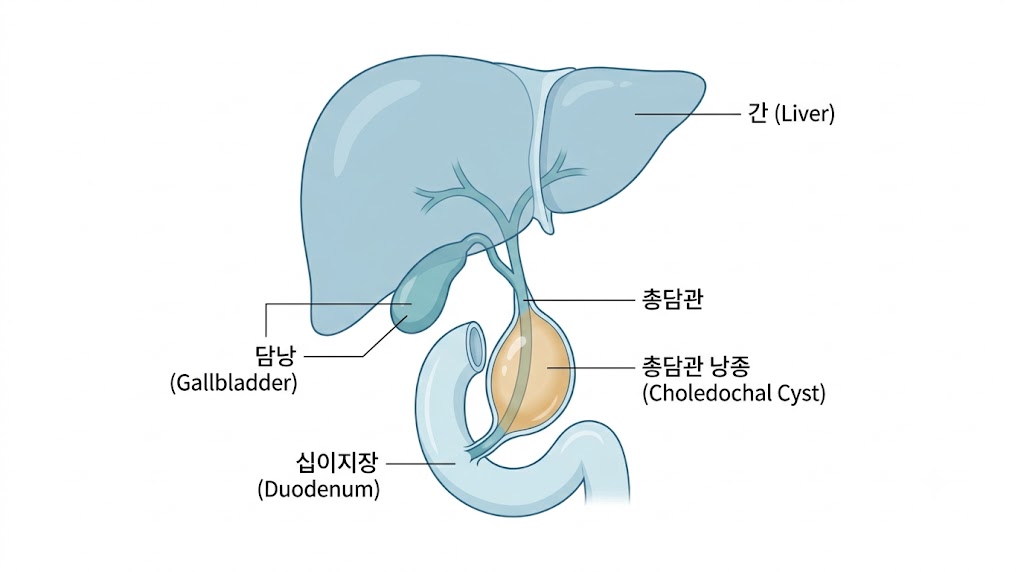 담즙성 낭종 발생 위치 — 총담관 해부학 구조 도해