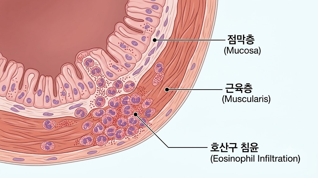호산구성 담낭염 원인 — 알레르기·기생충·약물 반응 담낭 침윤 메커니즘