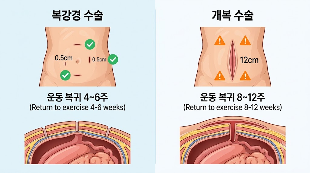 복강경 담낭 수술 vs 개복 수술 절개 부위와 운동 복귀 시기 비교 인포그래픽