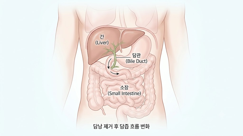 담낭 수술 후 체중 변화 — 음식 기피와 영양 불균형 설명 의학 일러스트