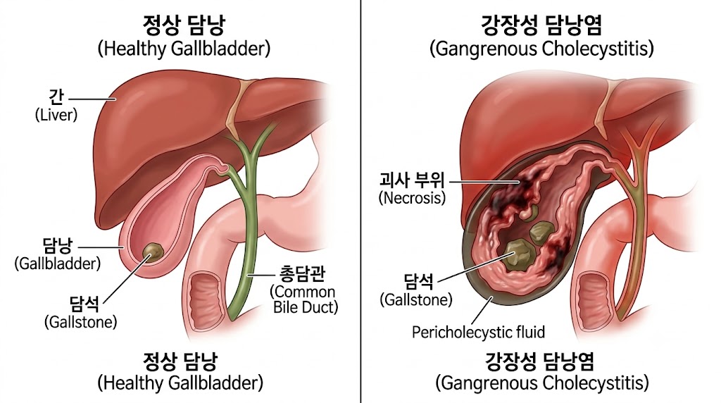 담낭 괴저 원인과 담낭 벽 괴사 진행 과정을 설명하는 의학 일러스트