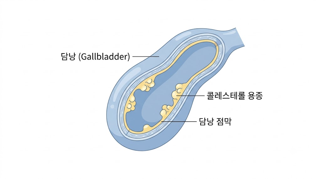 콜레스테롤 용종이 생긴 담낭 구조 의학 일러스트 — 담낭 점막 콜레스테롤 침착 부위 표시