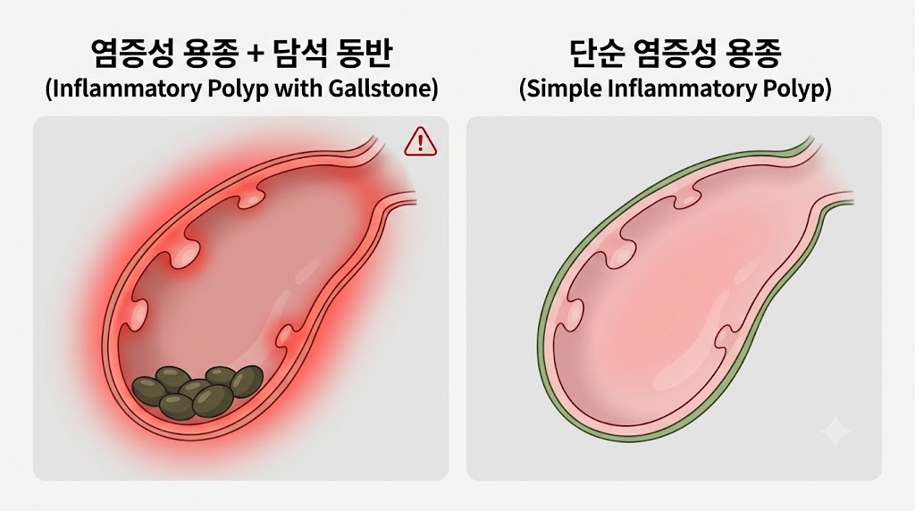 담낭 염증성 용종과 담석 동반 상태 비교 — 담낭 내부 구조 의학 일러스트