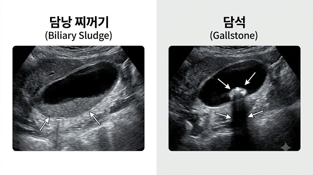 담낭 찌꺼기 vs 담석 초음파 비교 의학 일러스트