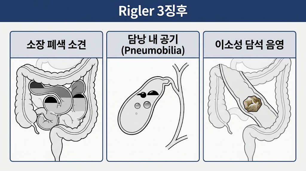 담석성 회장염 CT 및 X선 소견을 설명하는 의학 일러스트