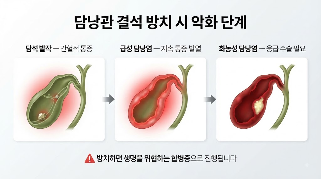 Alt Text: 담낭관 결석의 담낭염 악화 단계 — 폐쇄·염증·농양 진행 과정 인포그래픽