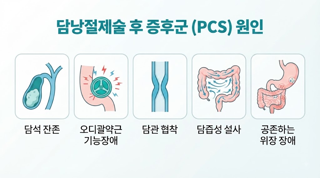: 담낭절제술 후 증후군 원인 5가지 — 담관, 담석 잔류, 오디 괄약근 등 해부 구조 의학 일러스트