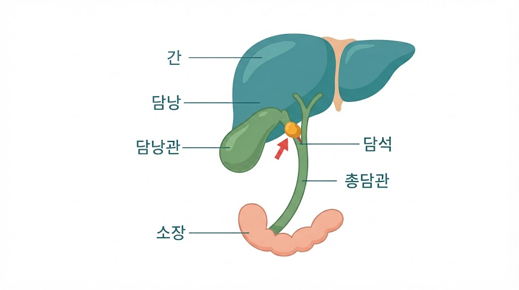 Alt Text: 담석 발작 원인 — 담낭관을 막는 담석 구조 해부 인포그래픽