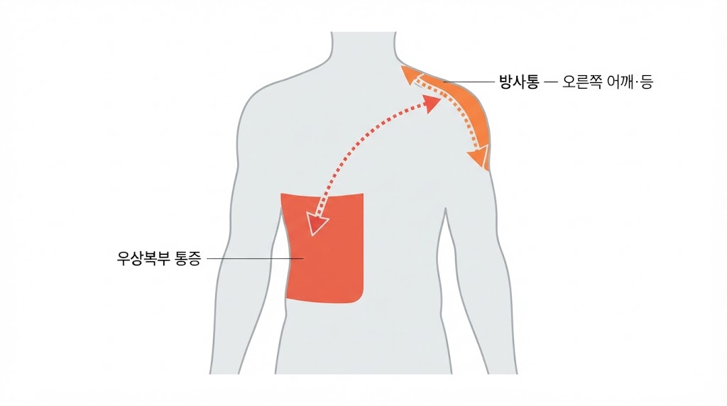 담석 발작 통증 위치 — 우상복부 및 오른쪽 어깨로 뻗는 방사통 자가진단