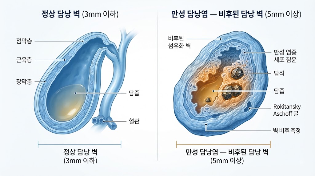 Alt Text: 만성 담낭염 — 반복 염증으로 두꺼워진 담낭 벽 단면 일러스트