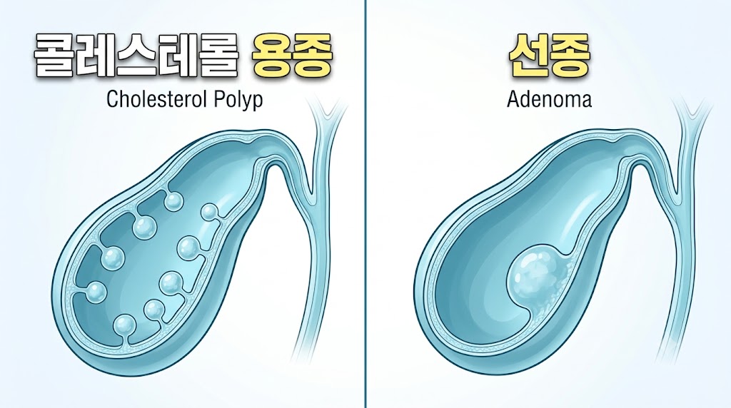 담낭용종 종류별 비교 — 콜레스테롤 용종과 선종의 차이