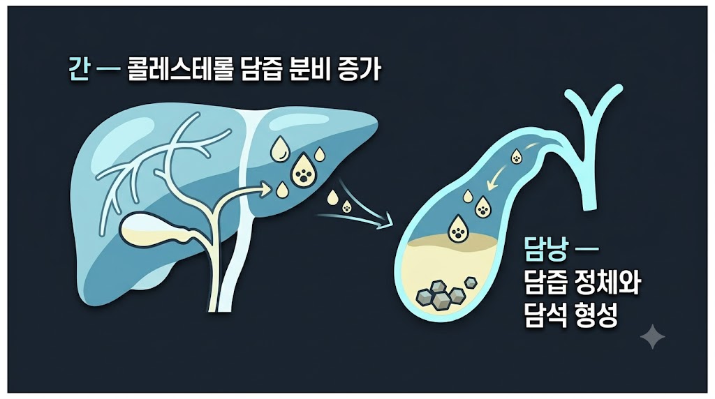 담석 형성 원리 — 간의 콜레스테롤 분비와 담낭 내 담즙 정체 모식도