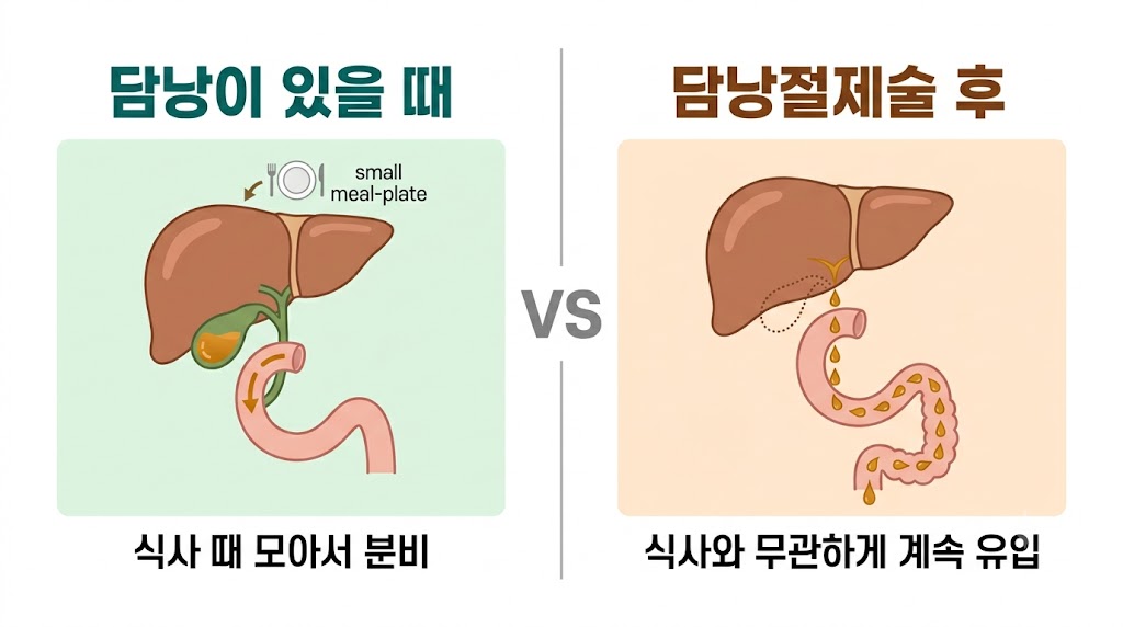 담낭이 있을 때와 담낭절제술 후 담즙 흐름 비교 일러스트