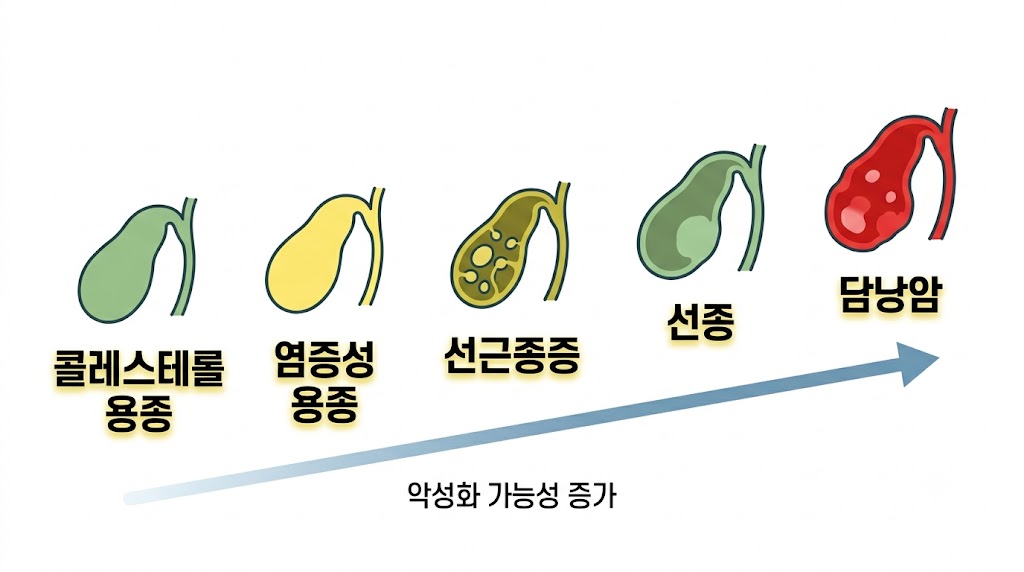 담낭용종 종류별 악성화 가능성 인포그래픽 — 콜레스테롤·염증성·선종 비교
